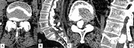 TWO CASES OF A SPINAL CORD TUMOR COMBINED WITH A LUMBAR STENOSIS