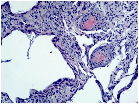 ASTROCYTOMA, MIMICKING ANGIOMATOUS MENINGIOMA