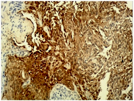 ASTROCYTOMA, MIMICKING ANGIOMATOUS MENINGIOMA