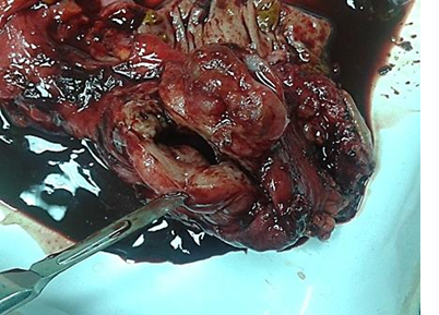 Deep infiltrating endometriosis mimicking rectal tumor