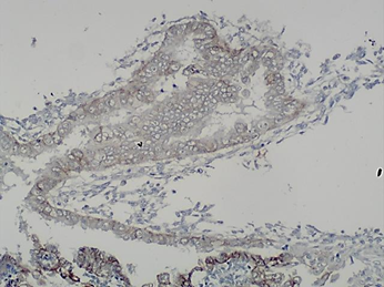 Deep infiltrating endometriosis mimicking rectal tumor