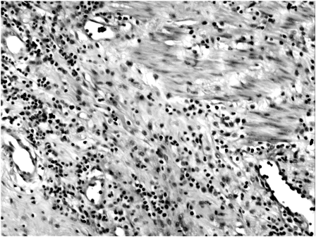 Benign inflammatory myofibroblastic tumor  in the wall of Meckel’s diverticulum